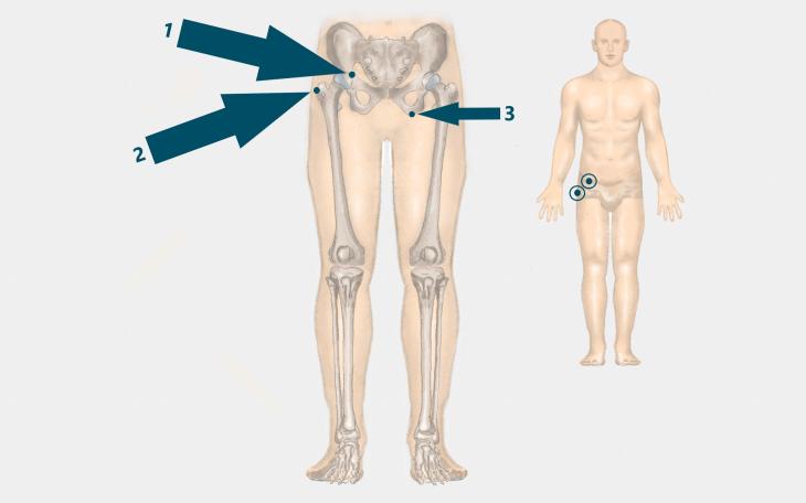 Lokalisation Schleimbeutelentzündung der Hüfte