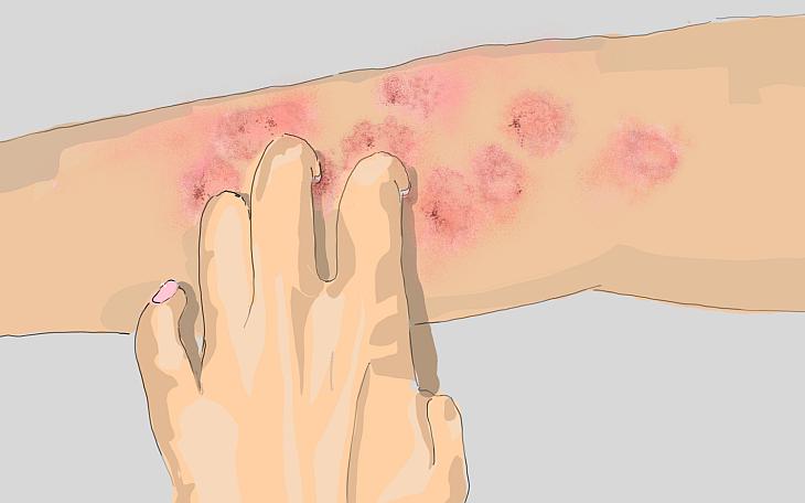 Chagas-Krankheit Chagas-Krankheit