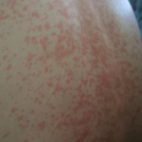 Bild eines Users zum Thema Röteln