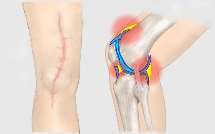 Arthrofibrose im Kniegelenk