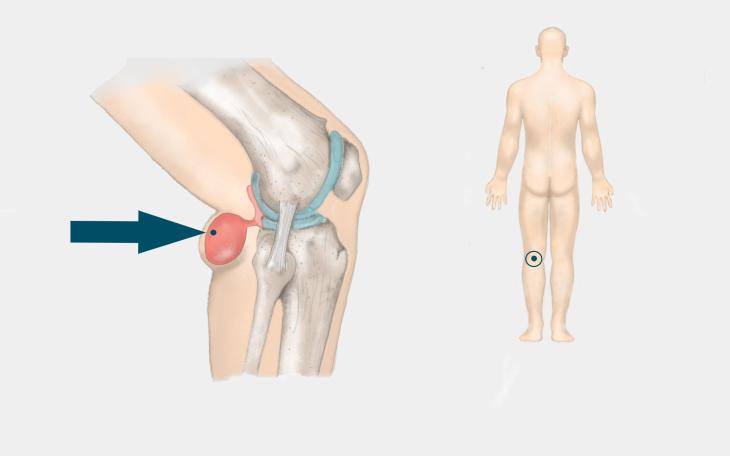 Lokalisation Bakerzyste