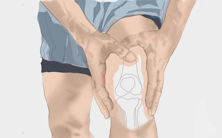 Chondropathia patellae Chondropathia patellae