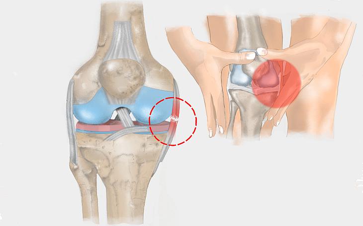 Innenbandriss im Kniegelenk