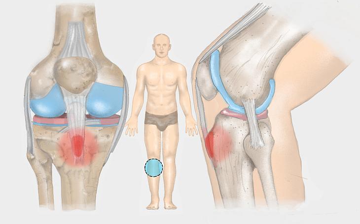 Morbus Osgood-Schlatter Morbus Osgood-Schlatter
