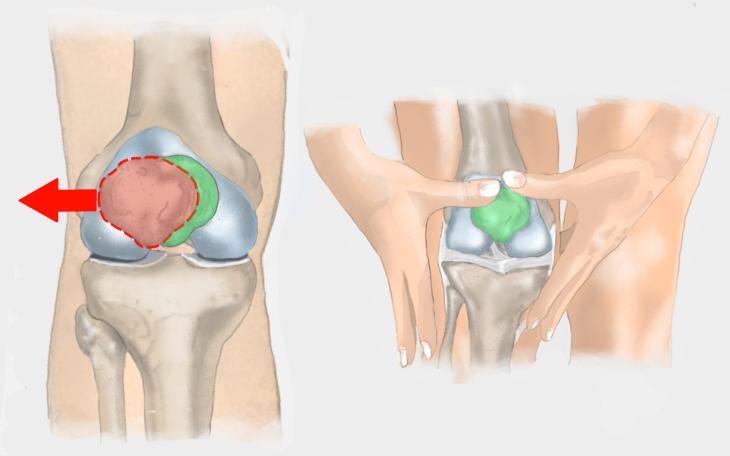 Patellalateralisation Patellalateralisation
