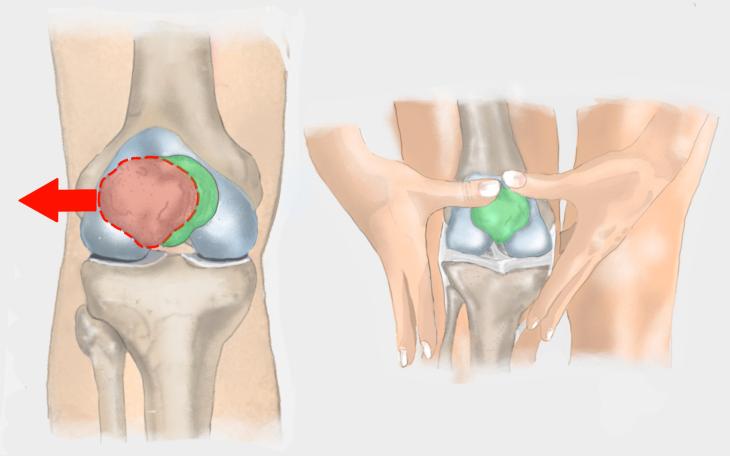 Patellalateralisation