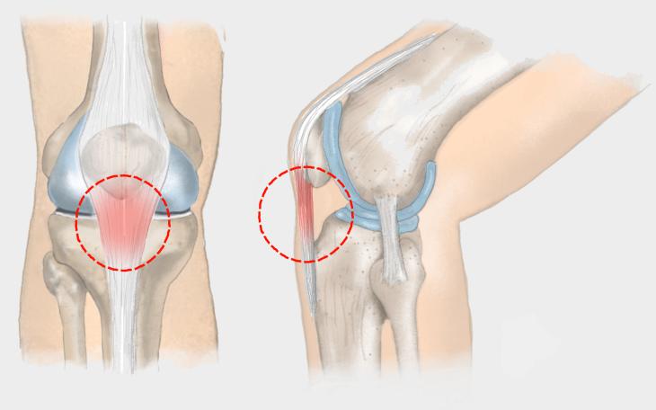 Entzündung der Patellasehne Entzündung der Patellasehne