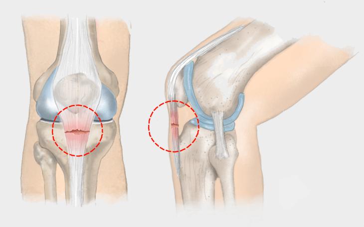Patellasehnenriss Patellasehnenriss