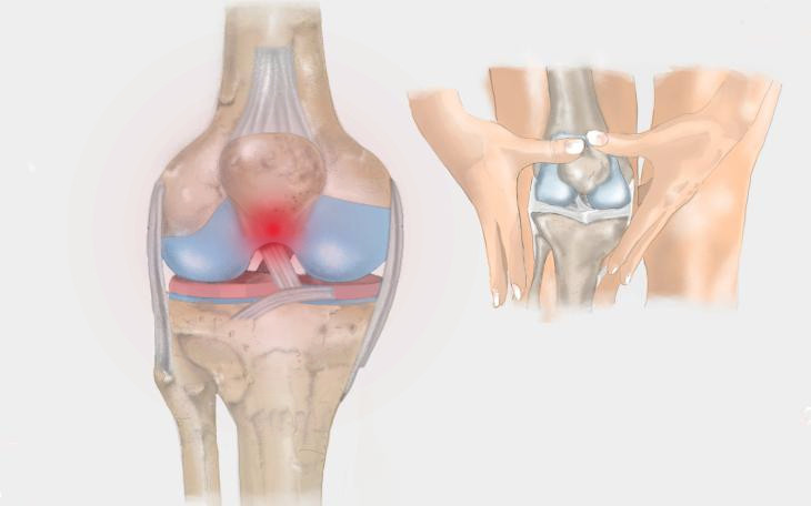 Patellaspitzensyndrom Patellaspitzensyndrom