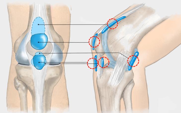 Lokalisation Schleimbeutelentzündung im Kniegelenk