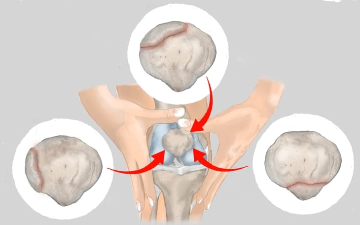 Patella bipartita Patella bipartita