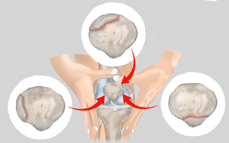 Patella bipartita