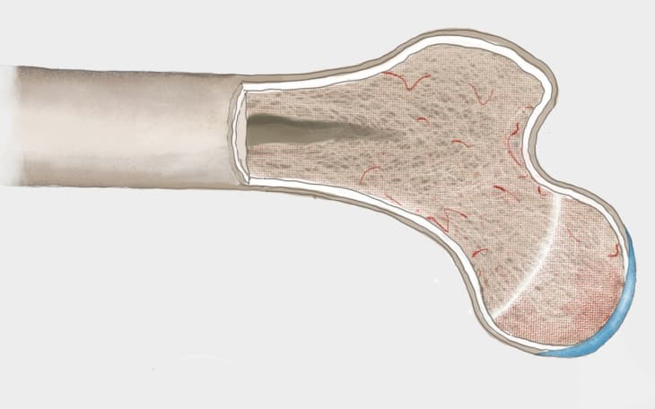 Osteomalazie