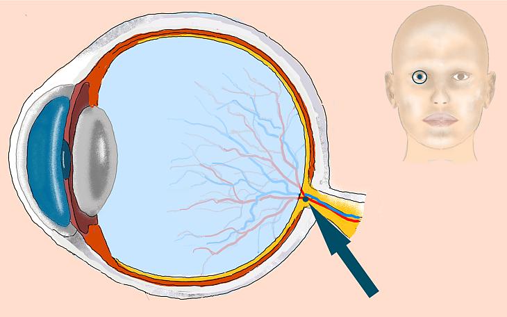 Lokalisation Arterienverschluss des Auges