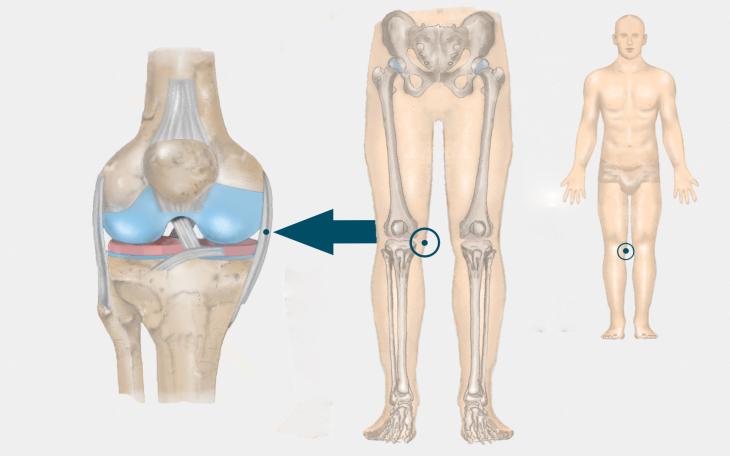 Lokalisation Innenbandriss im Kniegelenk