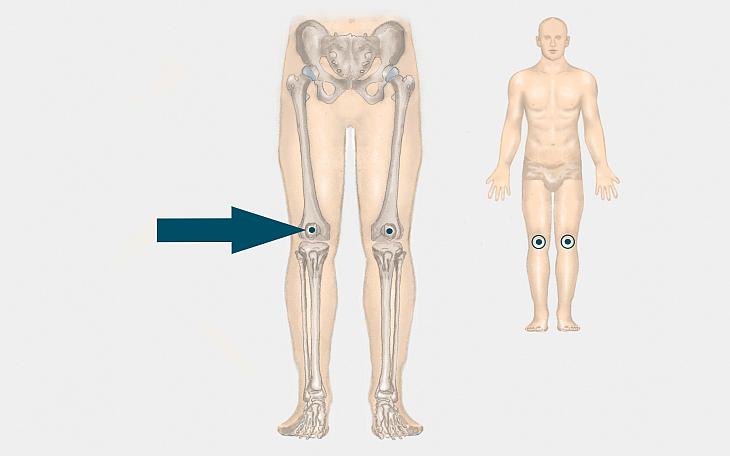 Lokalisation Kniegelenkserguss