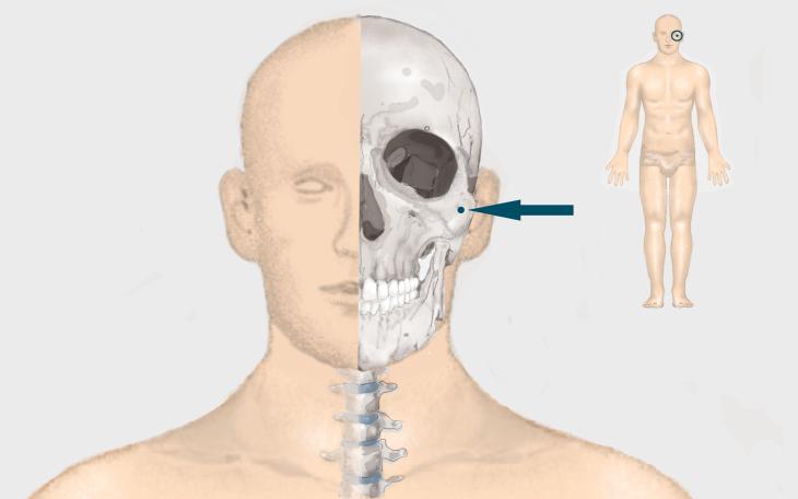 Lokalisation Jochbeinbruch