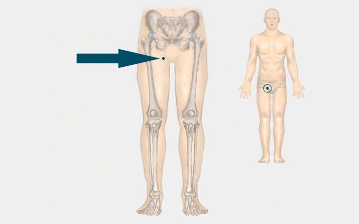Lokalisation Leistenschmerzen