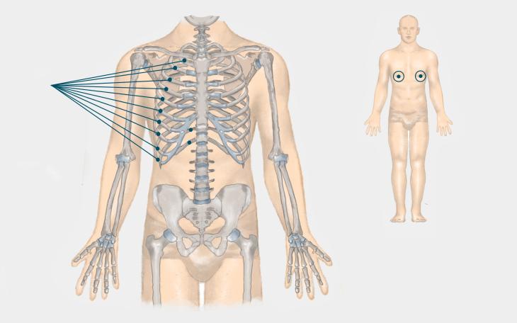 Lokalisation Rippenblockade