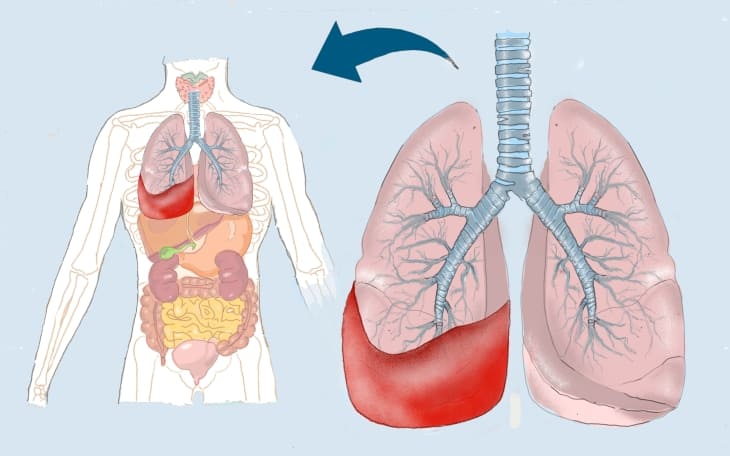 Hämatothorax
