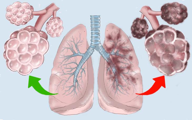 Lungenemphysem
