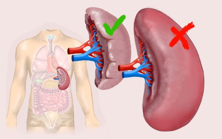 Splenomegalie (Milzvergrößerung)