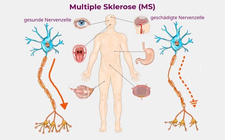 Multiple Sklerose