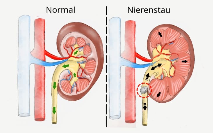 Nierenstau (Harnstau)