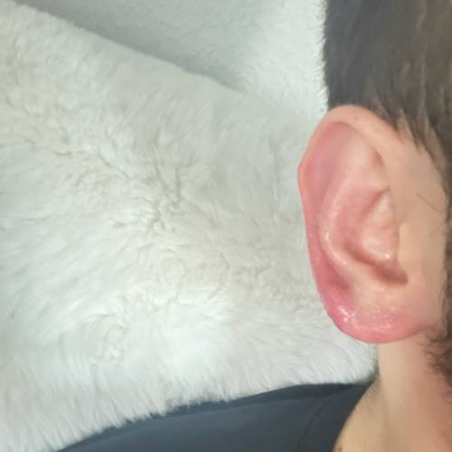 Bild eines Users zum Thema Entzündung der Ohrläppchen