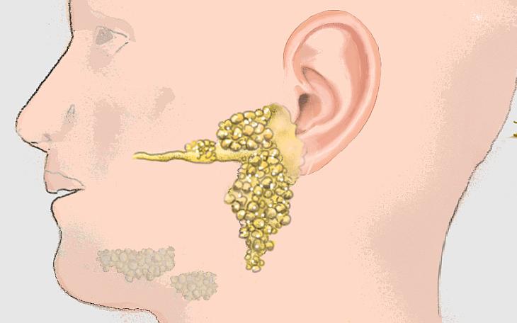 Ohrenschmerzen aufgrund einer Ohrspeicheldrüsenentzündung Ohrenschmerzen aufgrund einer Ohrspeicheldrüsenentzündung