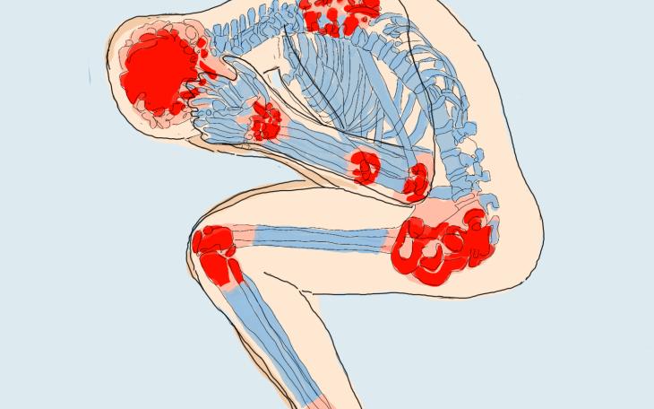 Fibromyalgie Fibromyalgie