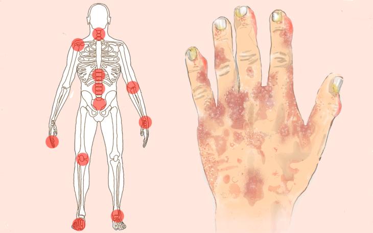 Psoriasis-Arthritis Psoriasis-Arthritis