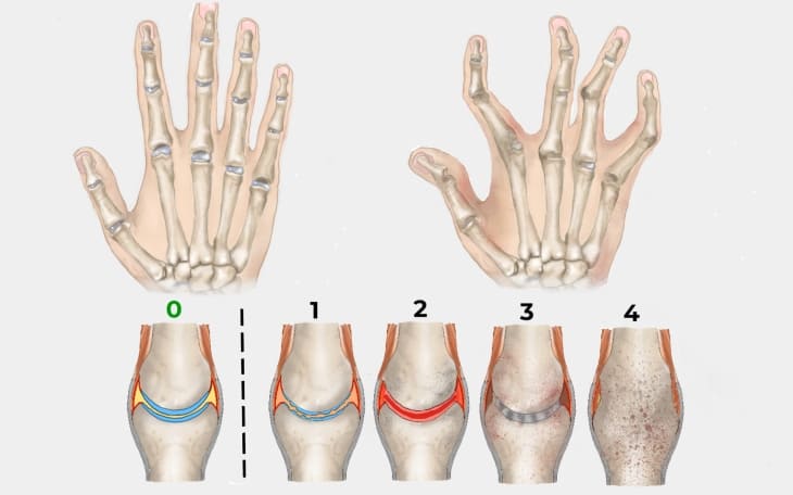 Rheumatoide Arthritis Rheumatoide Arthritis