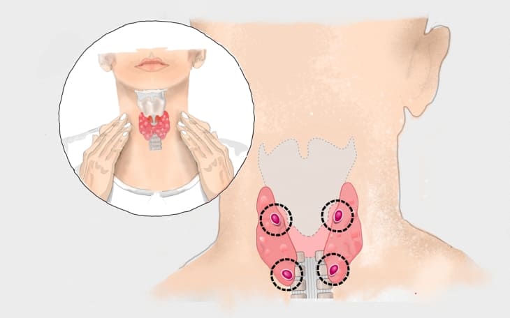 Nebenschilddrüsenunterfunktion