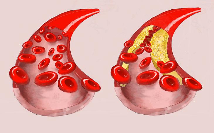 Hypercholesterinämie