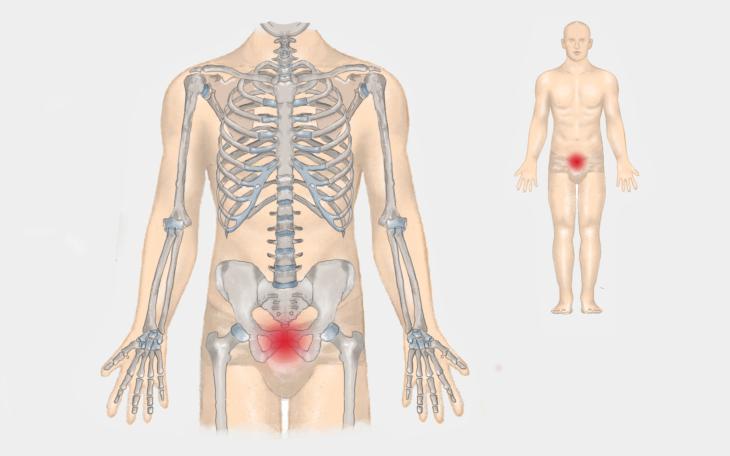 Lokalisation Schambeinentzündung