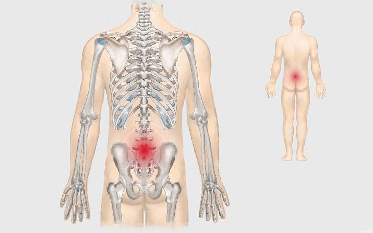 Lokalisation LWS-Syndrom