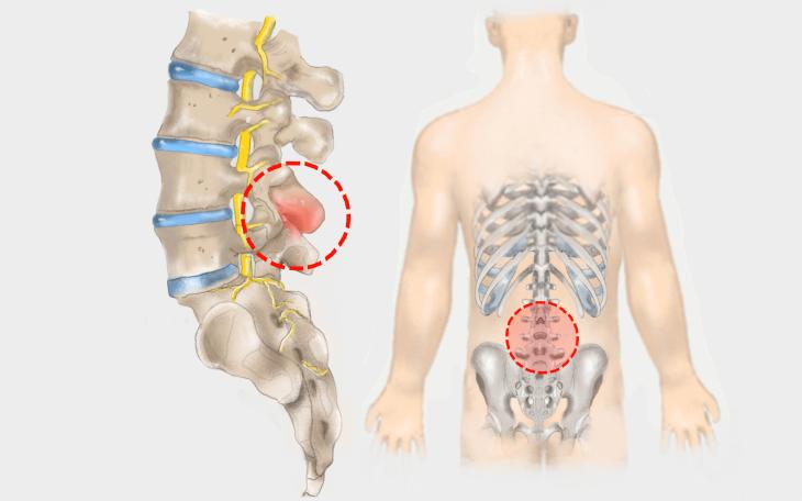 Morbus Baastrup Bild erkrankt