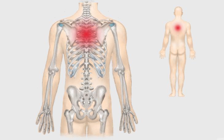 Lokalisation Morbus Scheuermann