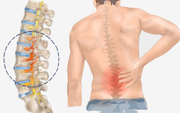 Myelitis (Rückenmarksentzündung)
