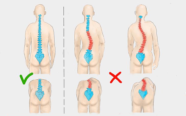 Skoliose Symptome Behandlung bungen Ursachen
