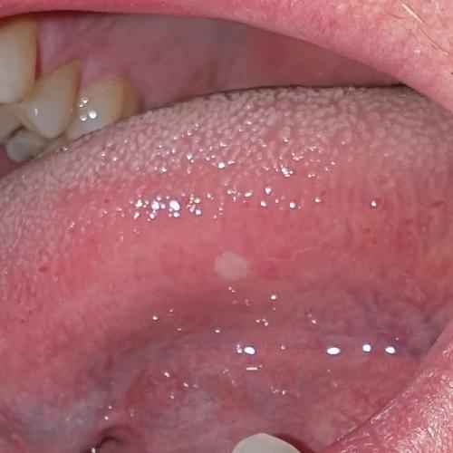 Bild eines Users zum Thema Aphthen