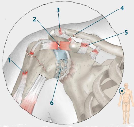 Lokalisation Schulterschmerzen