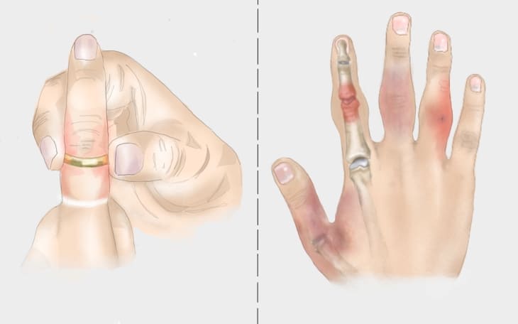 Geschwollene Finger