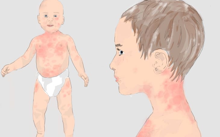 Hautausschlag bei Kindern am Bauch & Gesicht