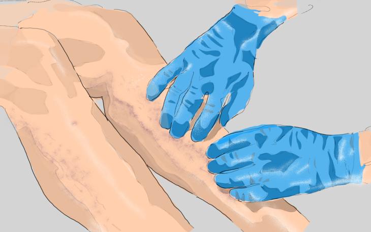 Durchblutungsstörung