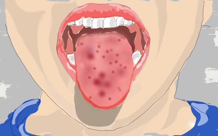 Rote Flecken auf der Zunge
