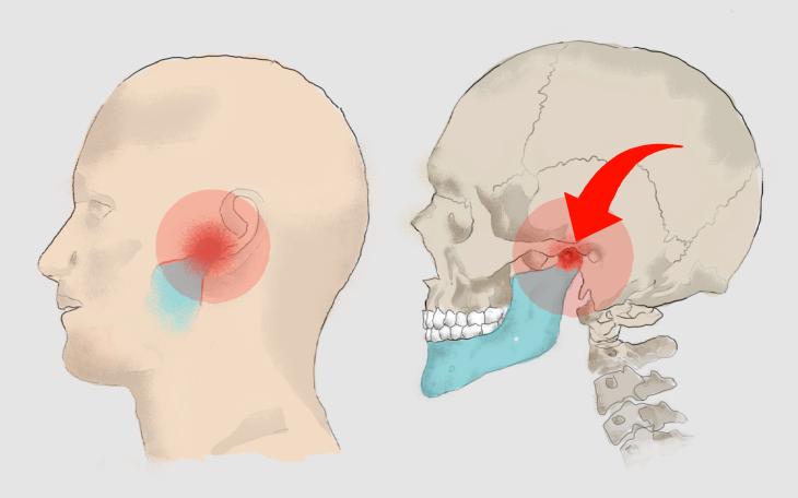 Schmerzen hinter dem Ohr Kiefergelenk