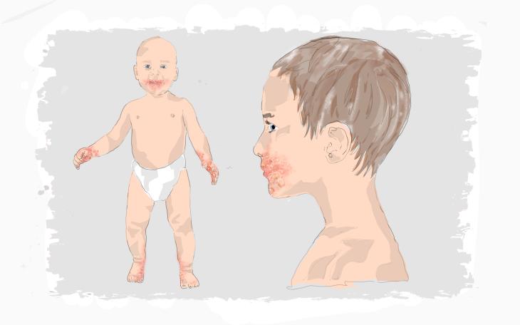 Rote Flecken beim Kind - Hand-Mund-Fuß-Krankheit