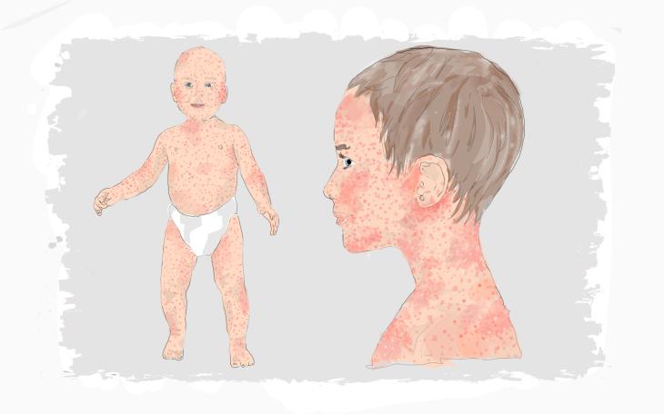 Masern als Ursache roter Flecken beim Kind.